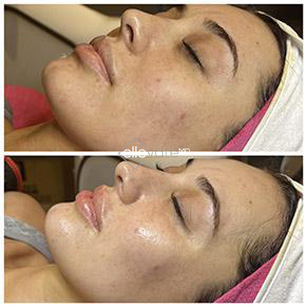JetPeel-Pro-Facial-Before-and-After-Image1