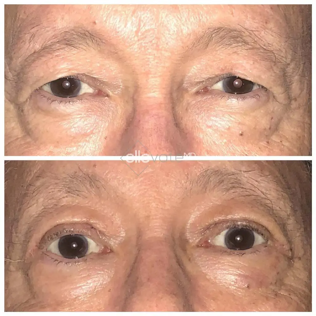 Ptosis-Repair-Before-and-After-Image13