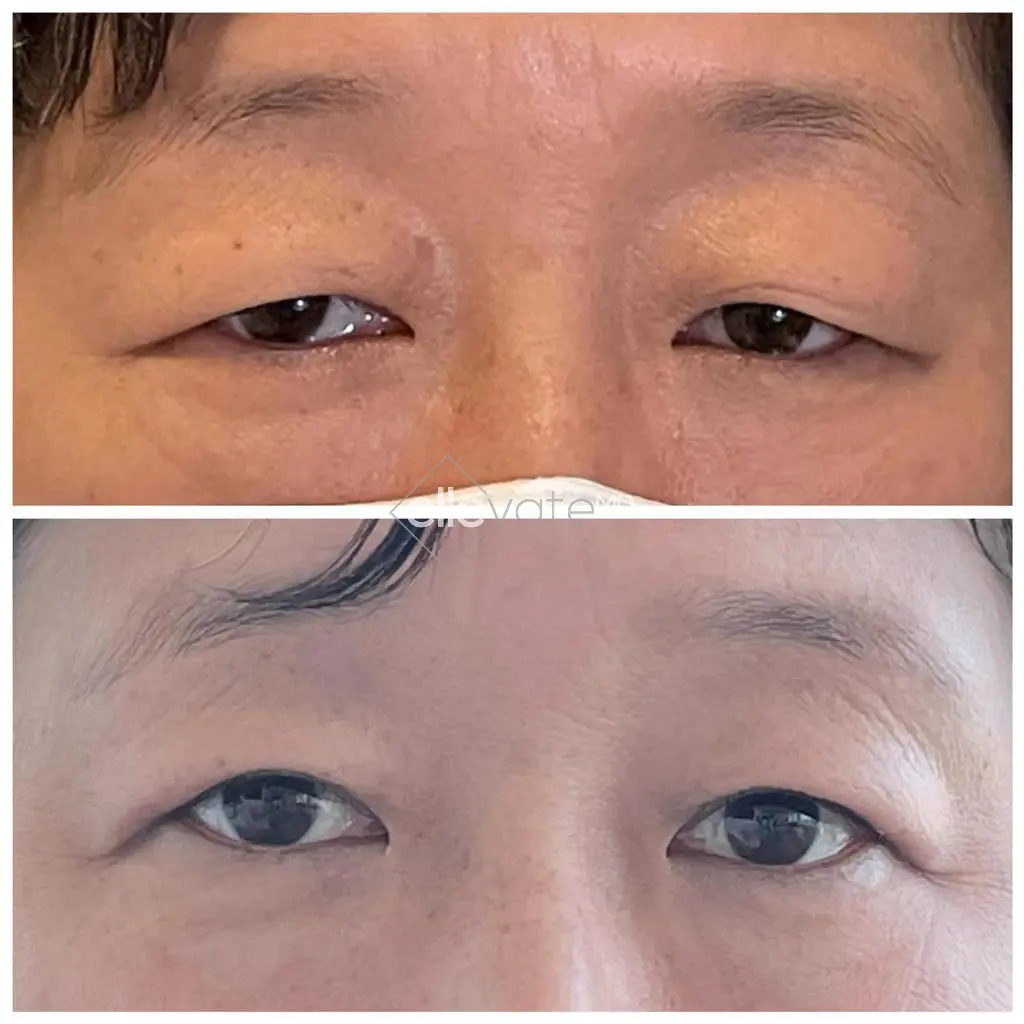 Ptosis-Repair-Before-and-After-Image19