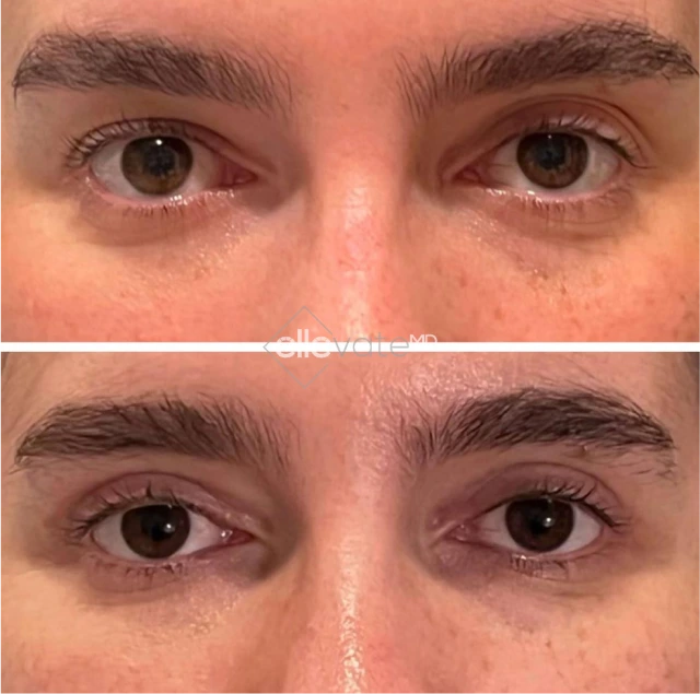 Blepharoplasty Before & After Banner