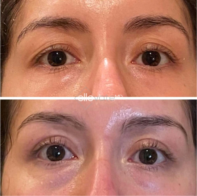 Blepharoplasty Before & After Banner