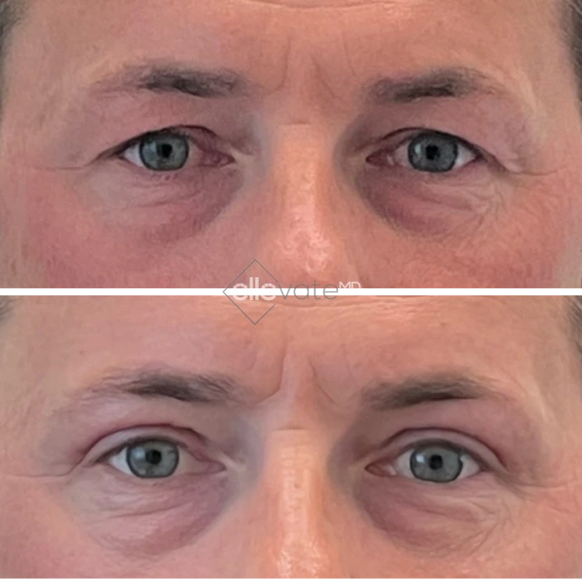 Blepharoplasty Before & After Banner