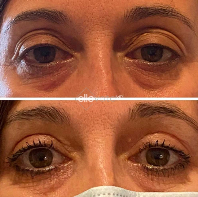 Blepharoplasty Before & After Banner