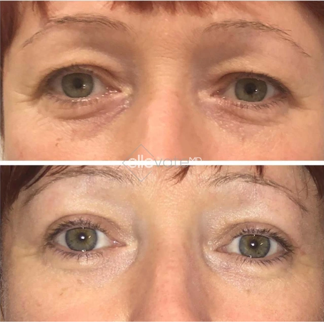 Blepharoplasty Before & After Banner