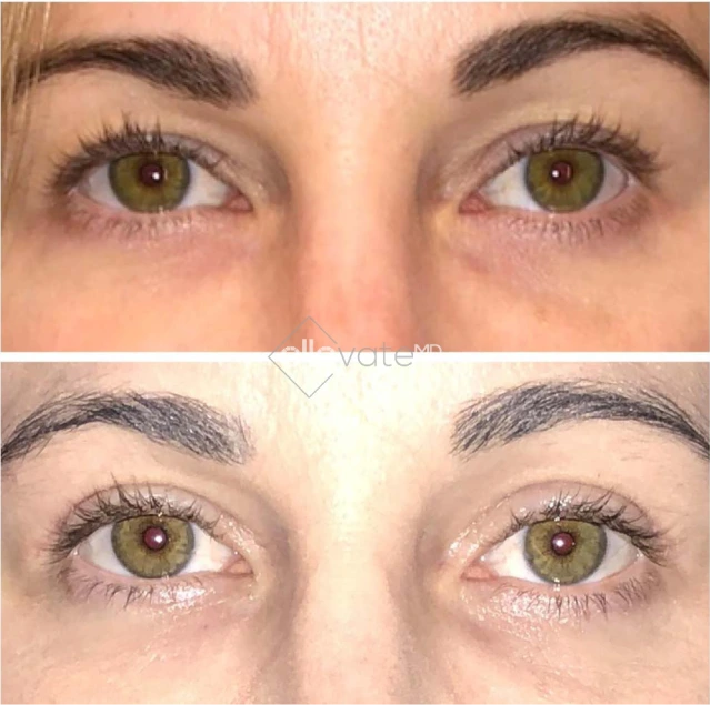 Blepharoplasty Before & After Banner