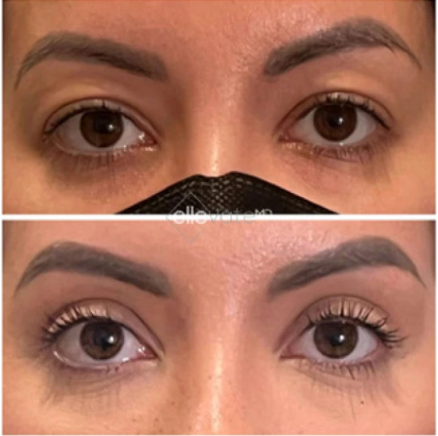 Blepharoplasty Before & After Banner