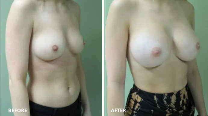Breast Augmentation - 2 - 2
