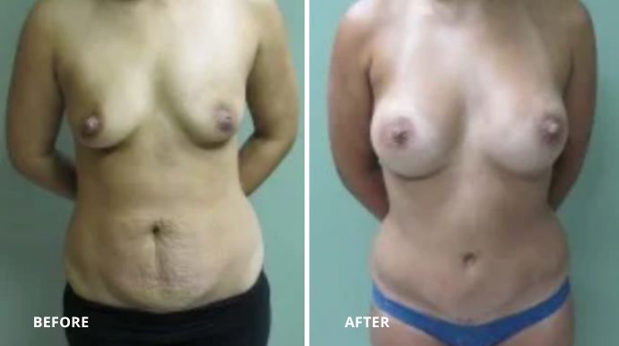 Breast Augmentation - 3 - 2