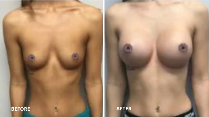Breast Augmentation - 5 - 1
