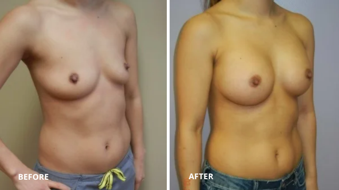 Breast Augmentation - 6 - 2