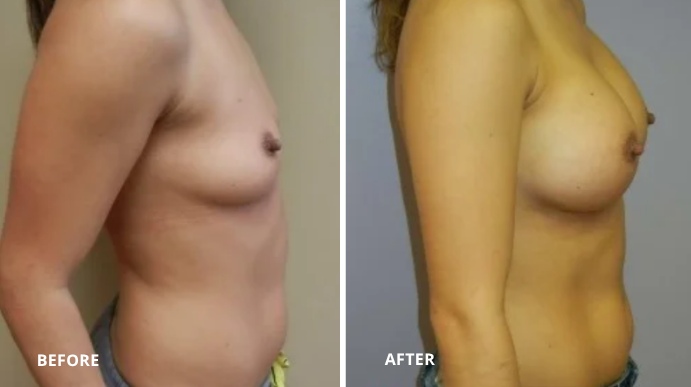 Breast Augmentation - 6 - 3