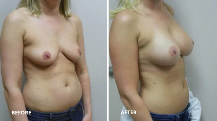 Breast Augmentation - 7 - 2