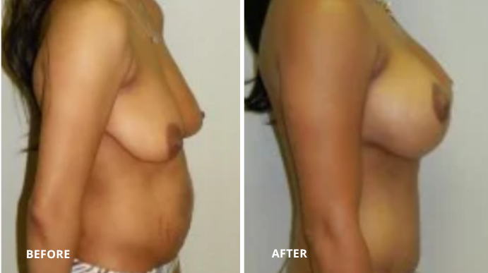 Breast Augmentation - 8 - 2
