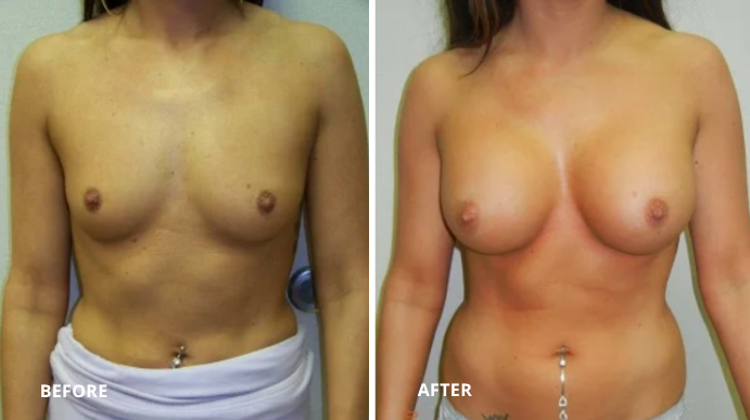 Breast Augmentation - 9 - 1