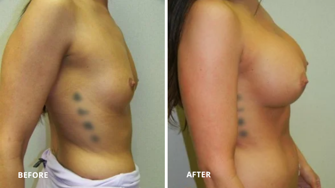 Breast Augmentation - 9 - 3