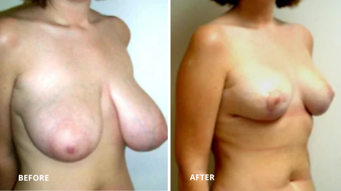 Breast Reduction - 2 - 2