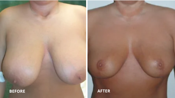 Breast Reduction - 3 - 1