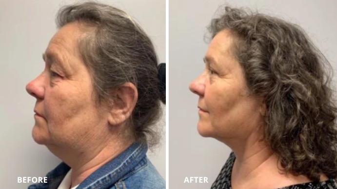 Eyelid Lift - Case 1 - 2