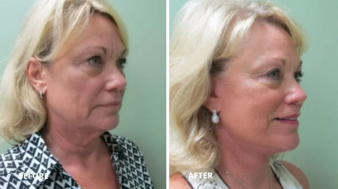 Facelift - Case 1 - 2