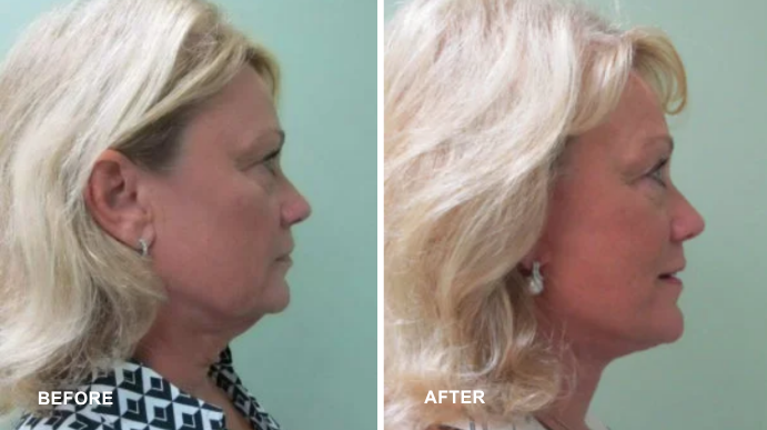 Facelift - Case 1 - 3