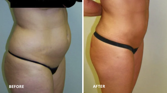 Liposuction - Case 1 - 1