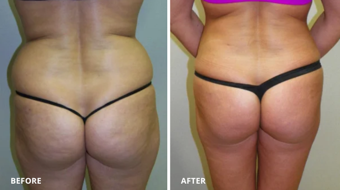 Liposuction - Case 1 - 3