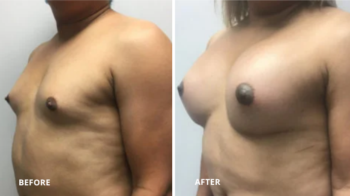 MTF Breast Augmentation - 1 - 2