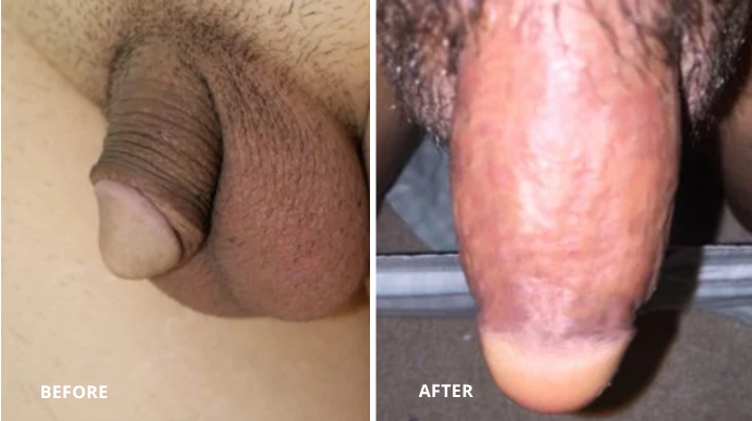 Penis Girth Enhancement - 3 - 1
