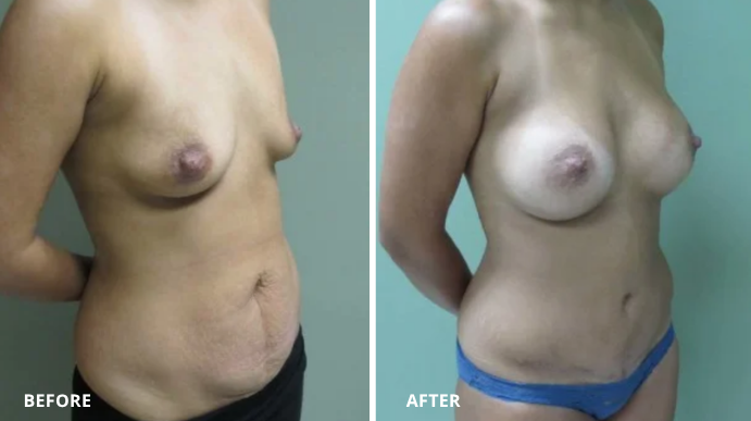 Tummy Tuck - Case 2 - 2