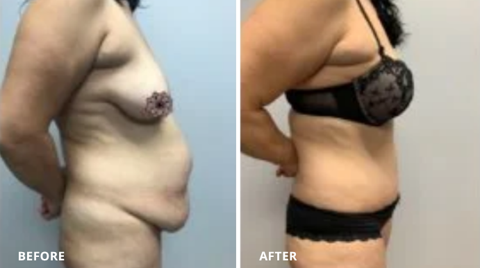 Tummy Tuck - Case 3 - 2