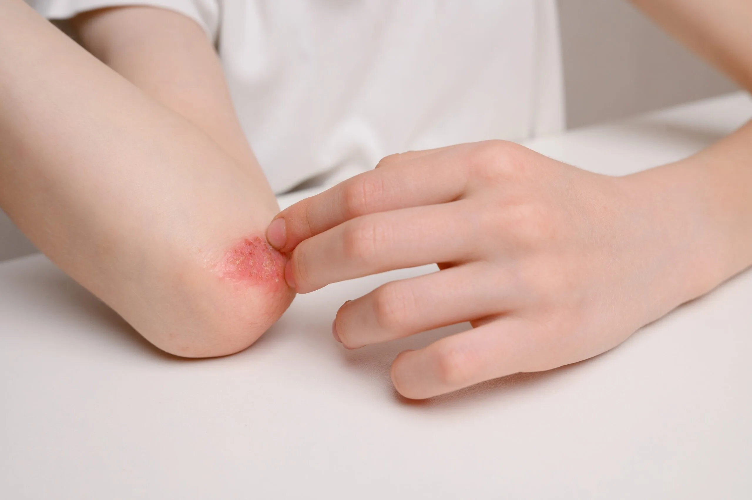 Close-up of a child's foot showing red, inflamed allergic contact dermatitis rash on the heel
