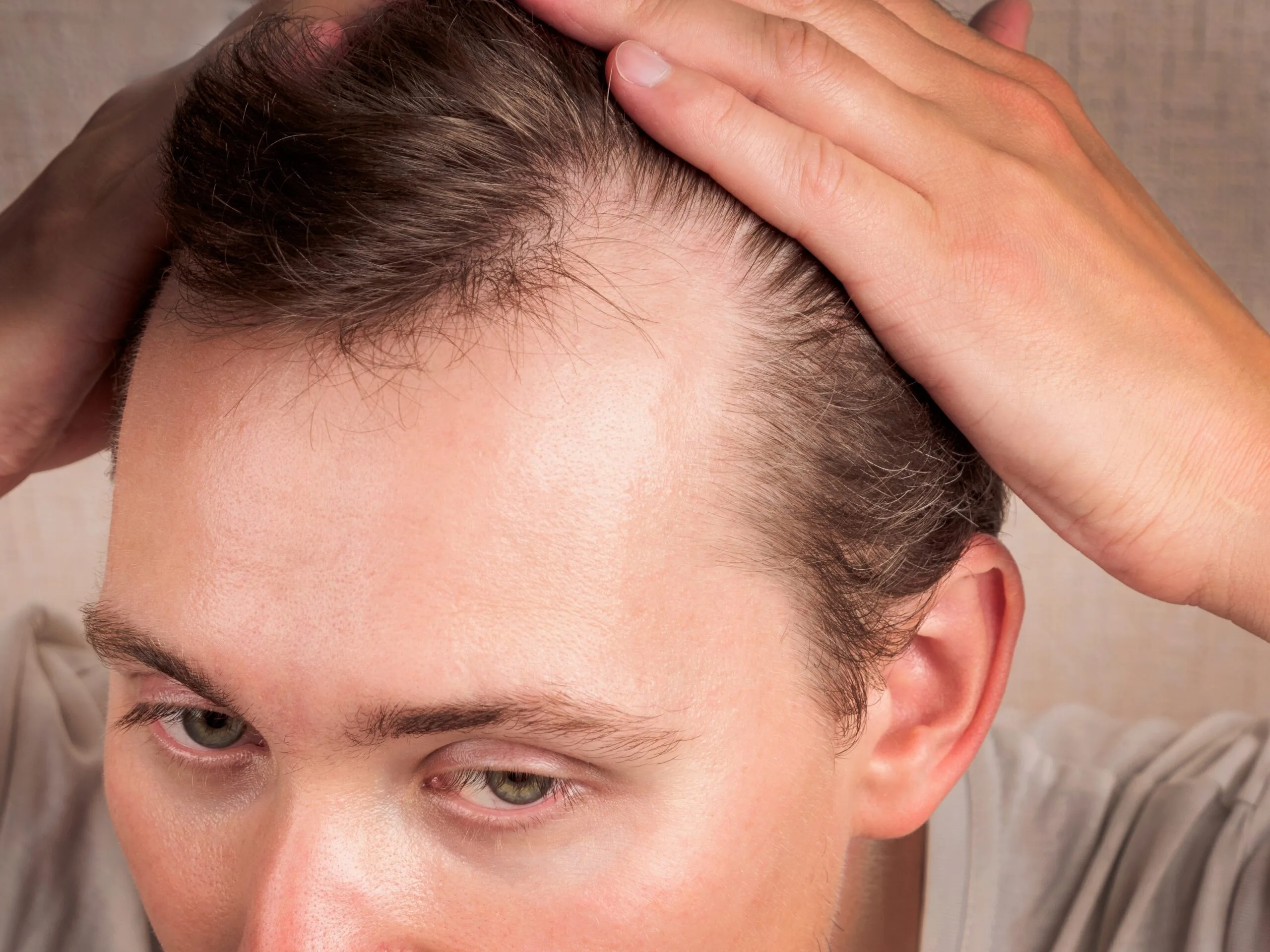 Man showing receding hairline and hair loss on the top and front of scalp