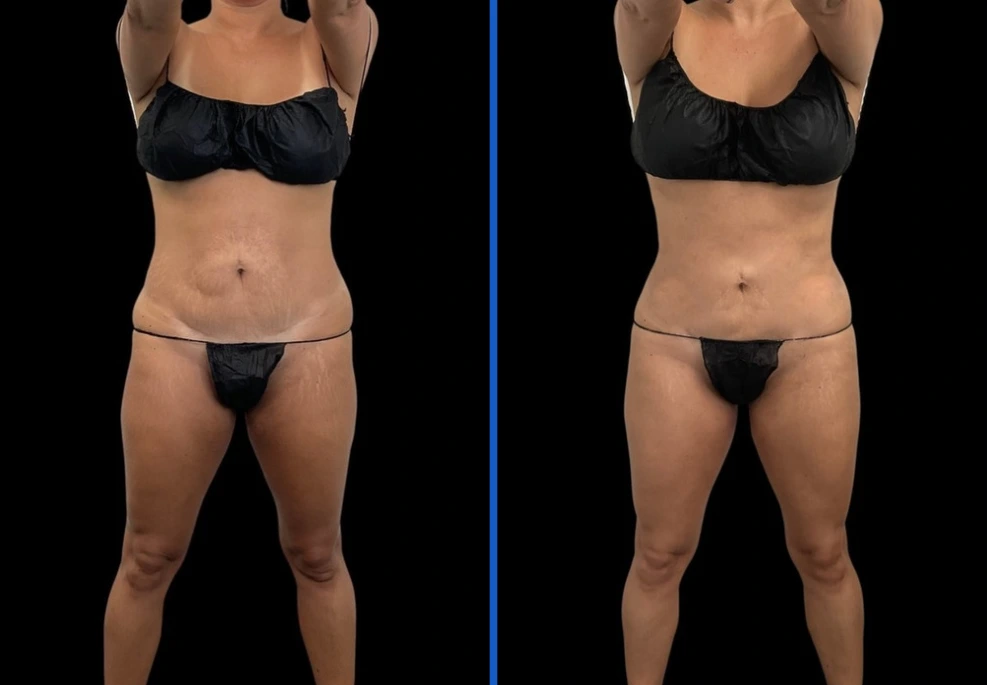 360-10 | Exert Clinic