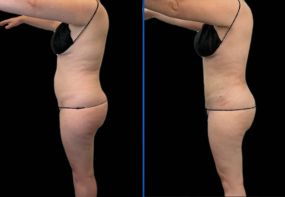 Case-0013-side-1-1|Exert Clinic