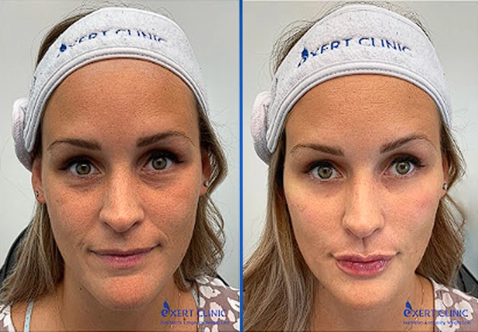 Filler-1c|Exert Clinic