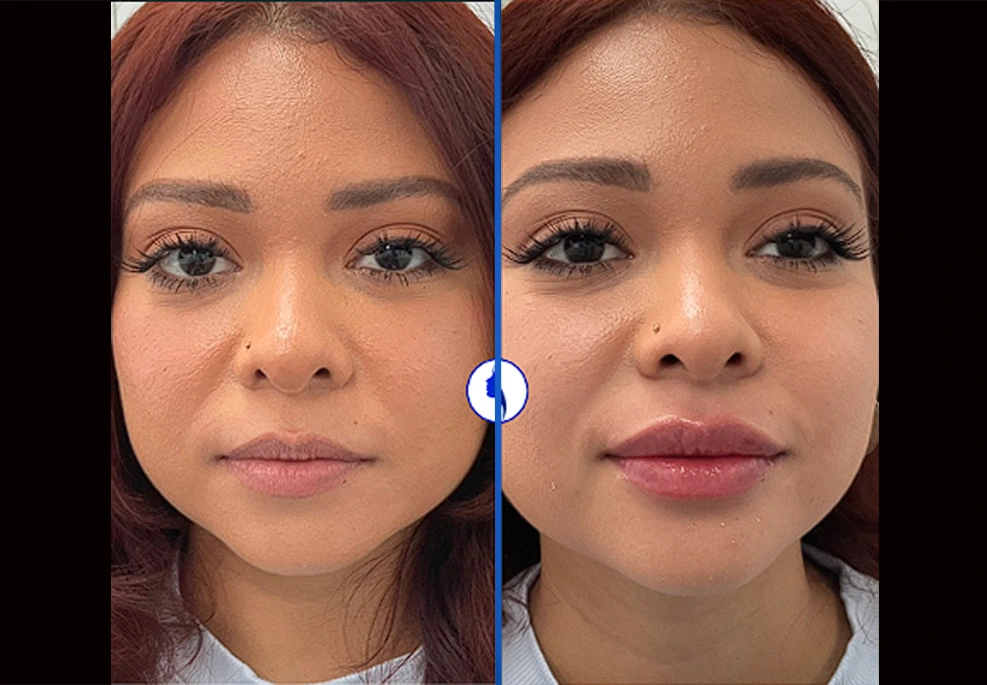 Filler-2a|Exert Clinic