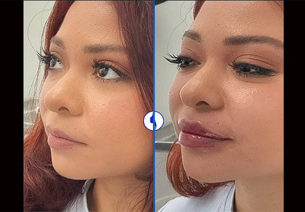 Filler-2b|Exert Clinic