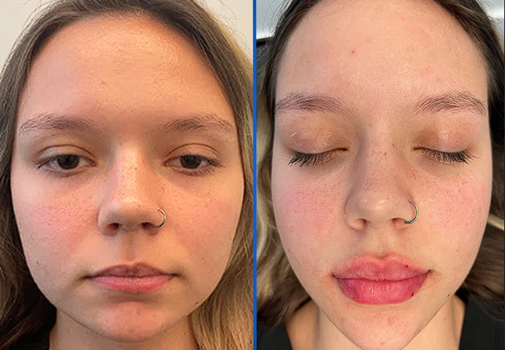 Filler-3c|Exert Clinic