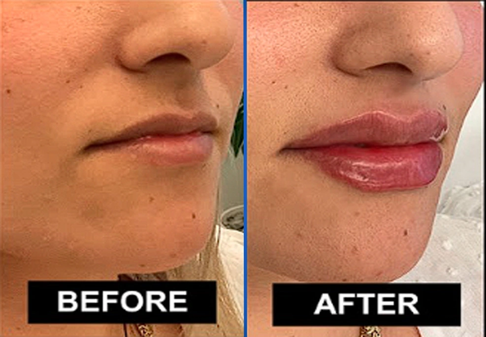 Filler-4a|Exert Clinic