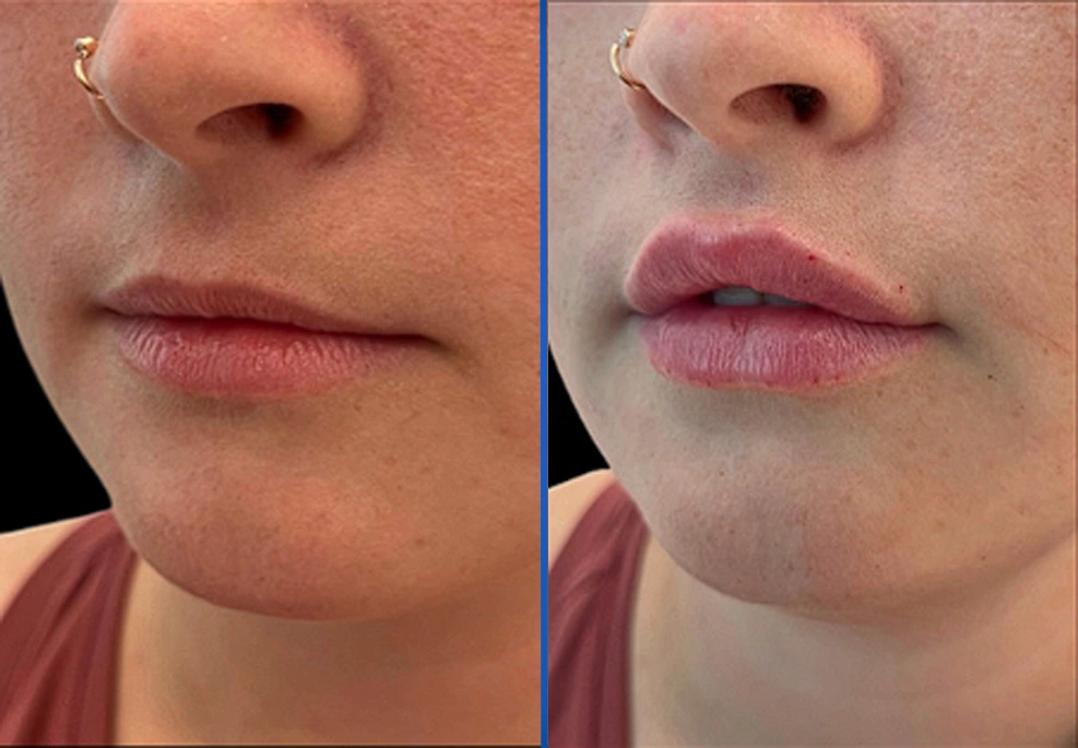 Filler-5a|Exert Clinic