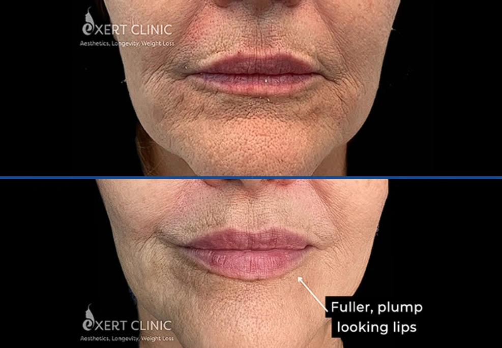 Filler-6|EXert Clinic