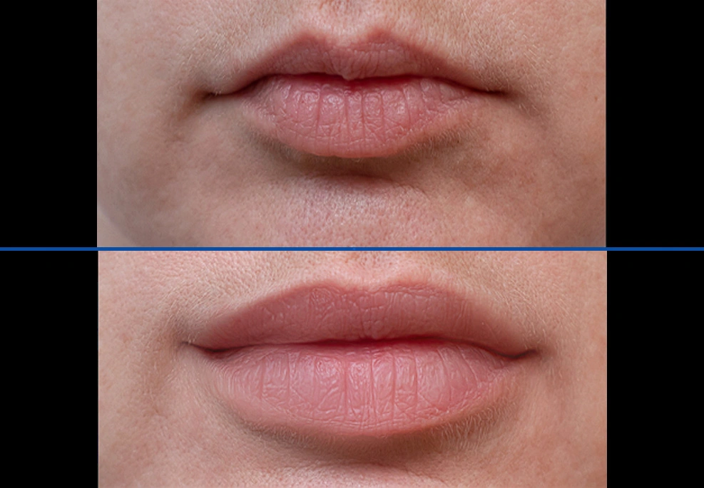 Filler-9|Exert Clinic