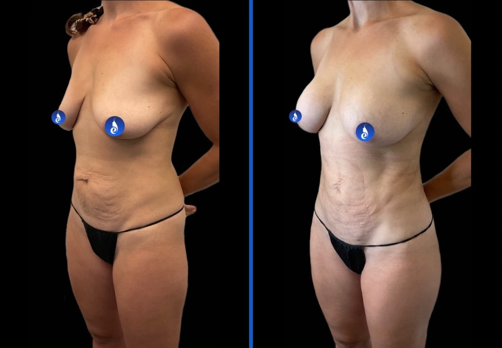breast1|Exert Clinic