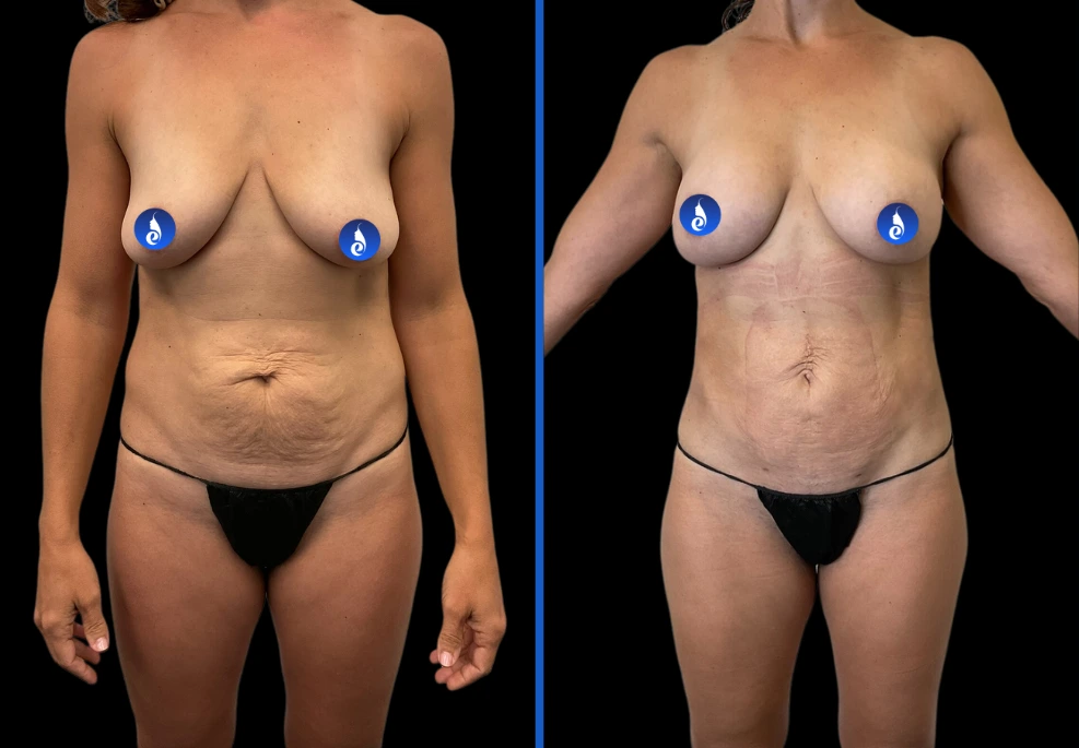 breast2|Exert Clinic