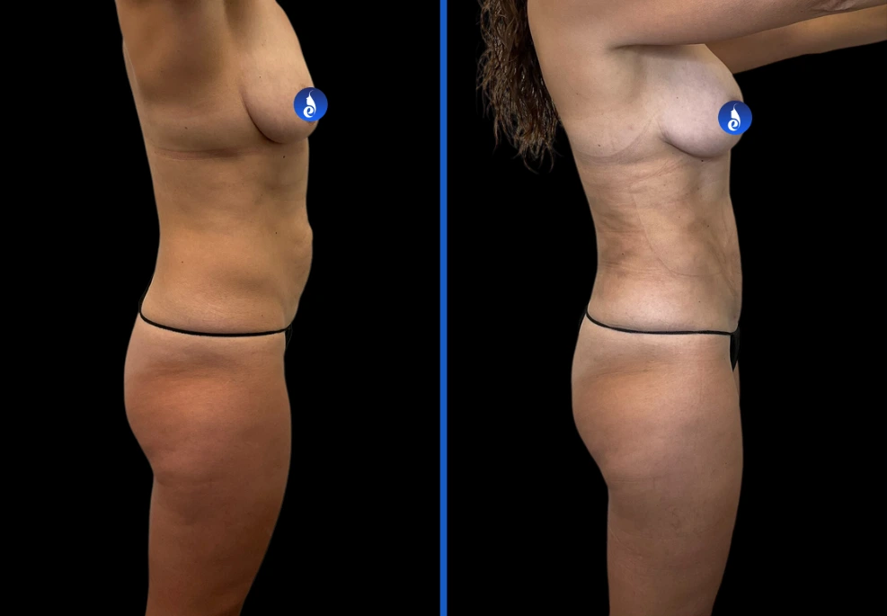 breast3|Exert Clinic