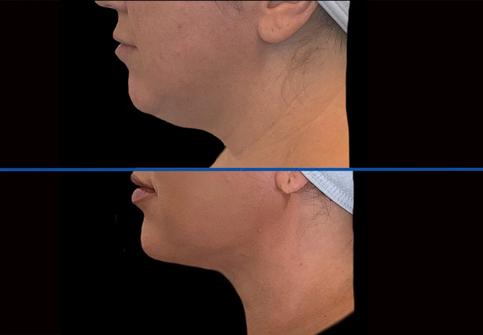 chin|Exert Clinic