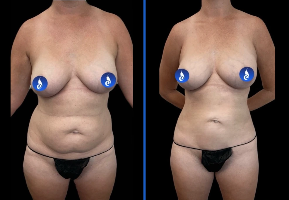 ab+breast|Exert Clinic