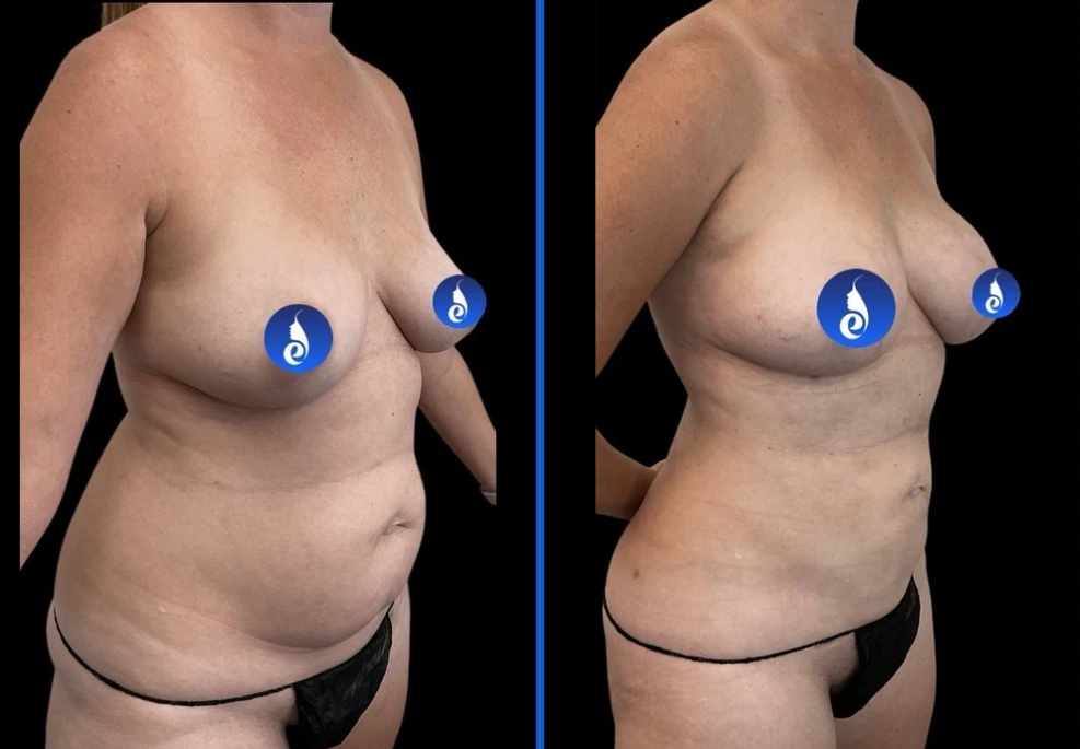 breast1.|Exert Clinic