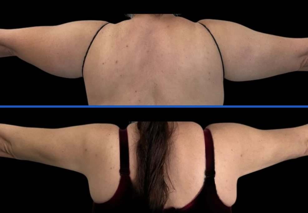 arm2|Exert Clinic