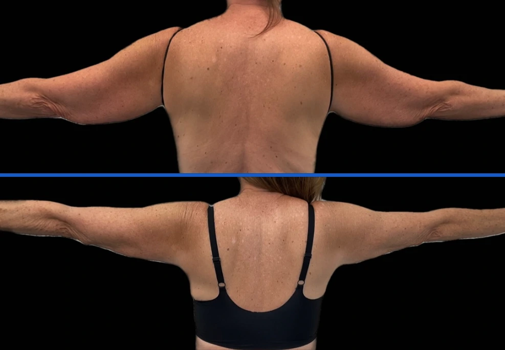 arm9|Exert Clinic